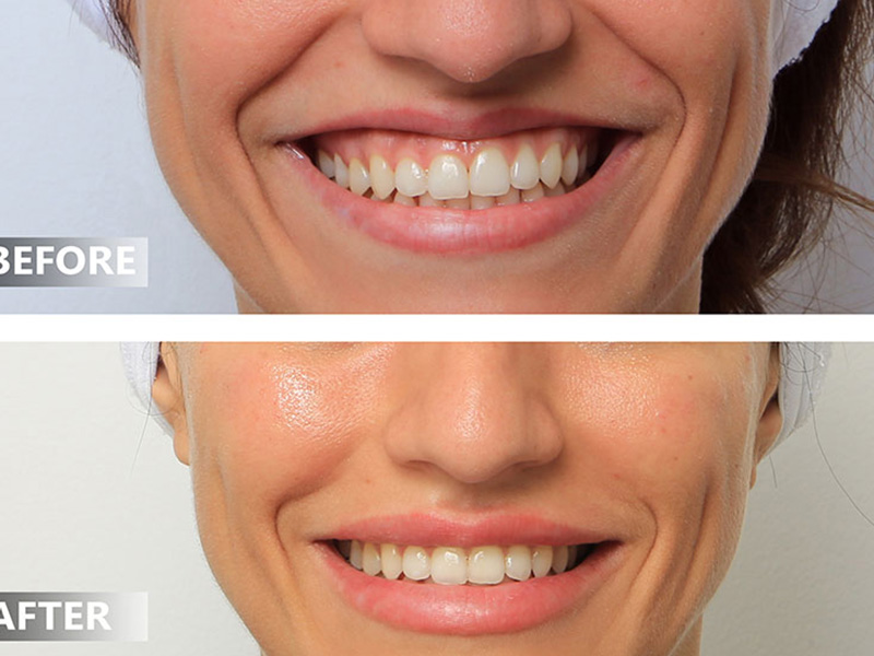 Xử lý tình trạng cười hở lợi hiệu quả